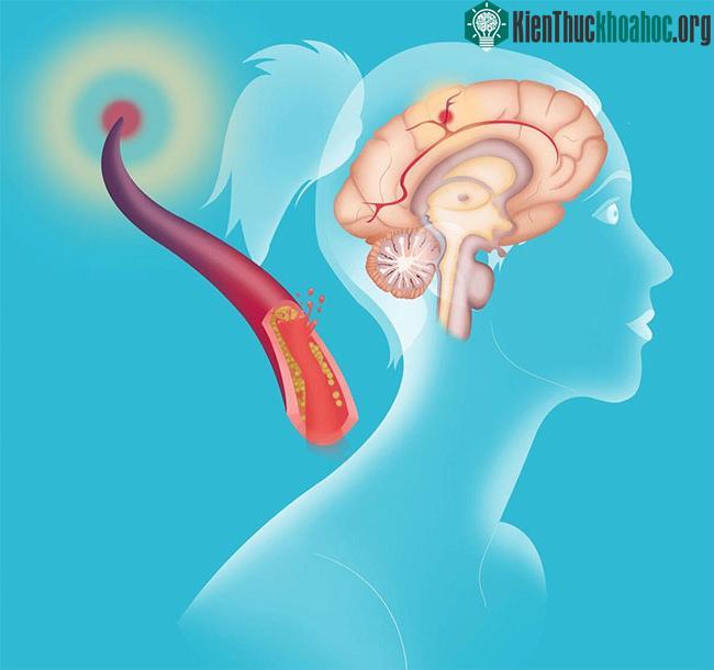 Làm sạch mạch máu – bí quyết tránh xa bệnh tim mạch