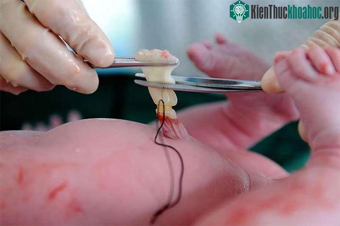 Lấy máu cuống rốn là kỹ thuật dễ thực hiện, an toàn cho mẹ và bé.