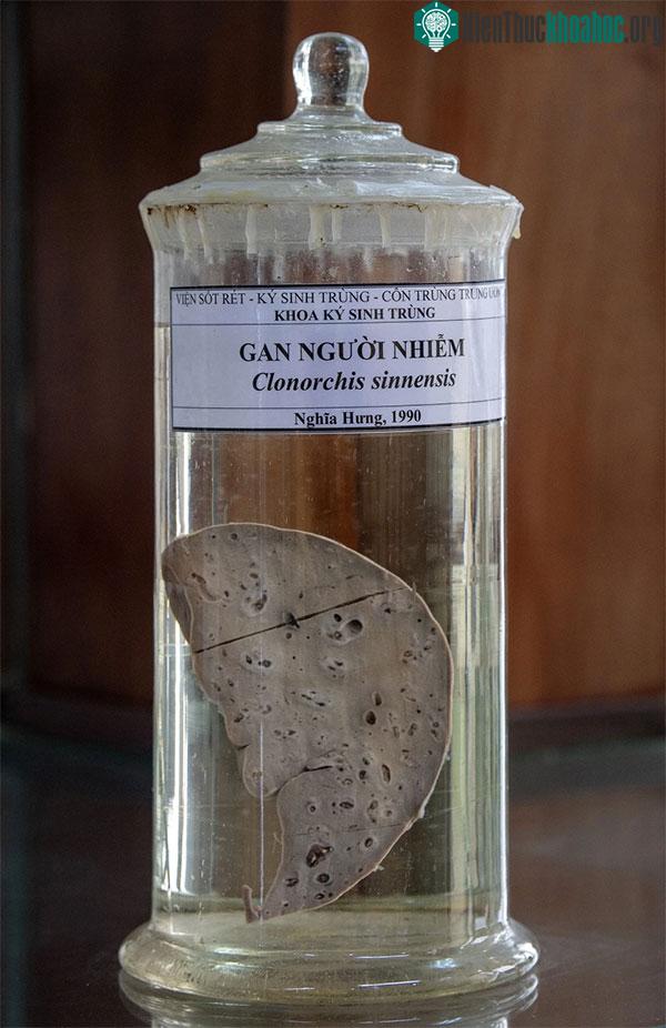 Một mẫu vật gan người nhiễm sán được ngâm trong dung dịch formol