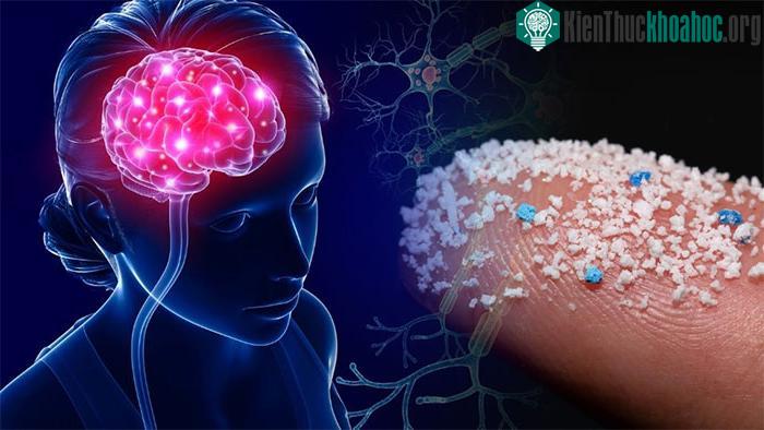 &nbsp;Hạt vi nhựa hay nhựa nano siêu nhỏ ngày càng được tìm thấy trong não bộ của con người