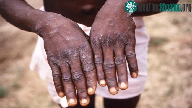 Bệnh nhân mắc đậu mùa khỉ ở Cộng hòa Dân chủ Congo.