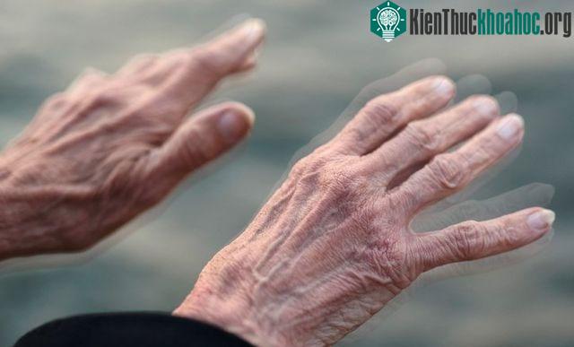 Bệnh Parkinson là một chứng rối loạn thoái hóa thần kinh