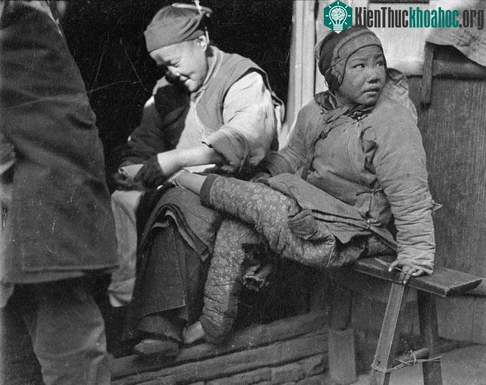 Các phụ nữ giúp nhau bó chân, chụp tại Chiết Giang, khoảng 1917-1919.