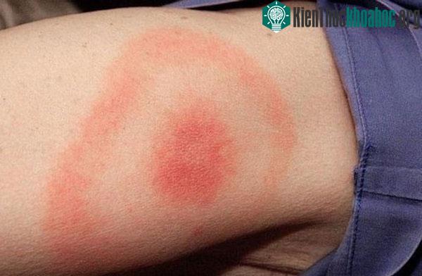Dấu hiệu của bệnh lyme là một vết sưng nhỏ, màu đỏ, tương tự như vết sưng của vết muỗi đốt.
