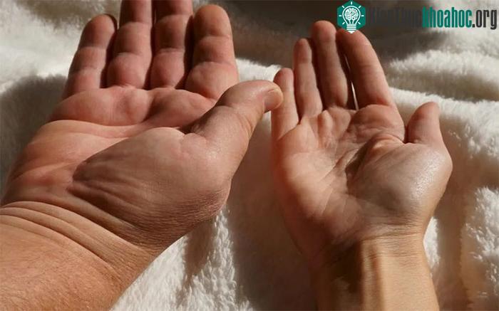 Acromegaly không phân biệt giới tính, nam và nữ có nguy cơ mắc bệnh ngang nhau.