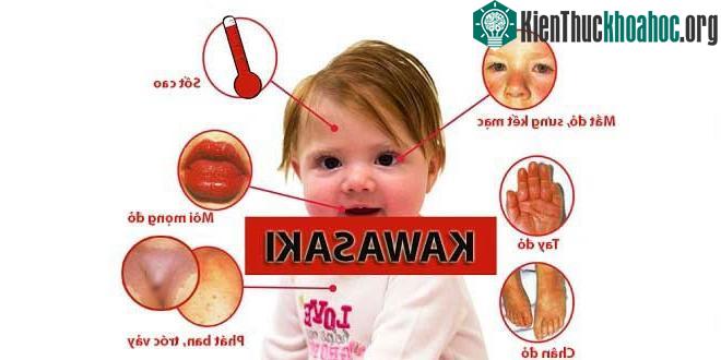 Một số biểu hiện của trẻ khi bị Kawasaki.