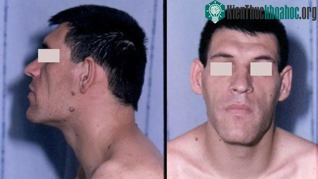 Acromegaly thường xuất hiện sau tuổi dậy thì, phổ biến nhất trong độ tuổi từ 40 đến 50