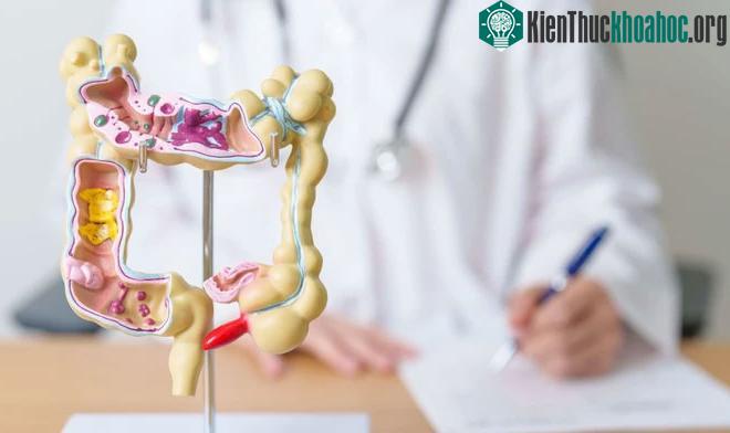 Tại sao ung thư đại tràng lại thường xuất hiện phía bên trái? ảnh 1