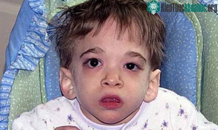 Brooke cần phải cho ăn thông qua một ống mở trong dạ dày.
