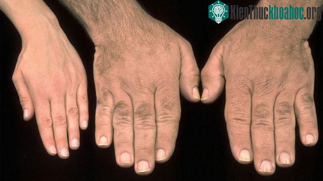 Acromegaly là một bệnh lý phức tạp nhưng có thể điều trị được.