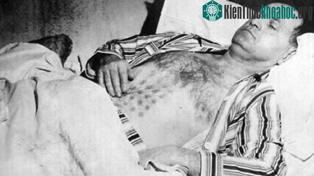 Stephen Michalak và những vết bỏng trên cơ thể.