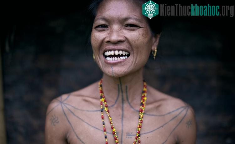 Hàm răng của phụ nữ sau khi được mài.
