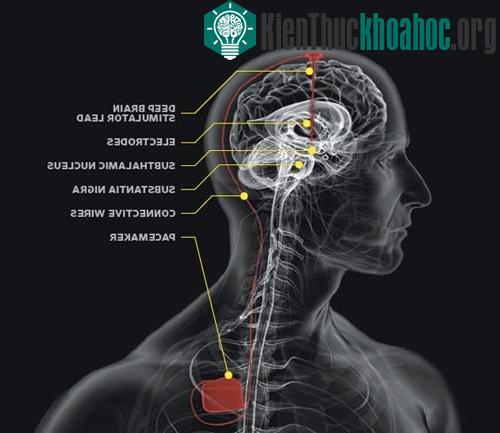 Phương thức để chữa trị căn bệnh Parkinson