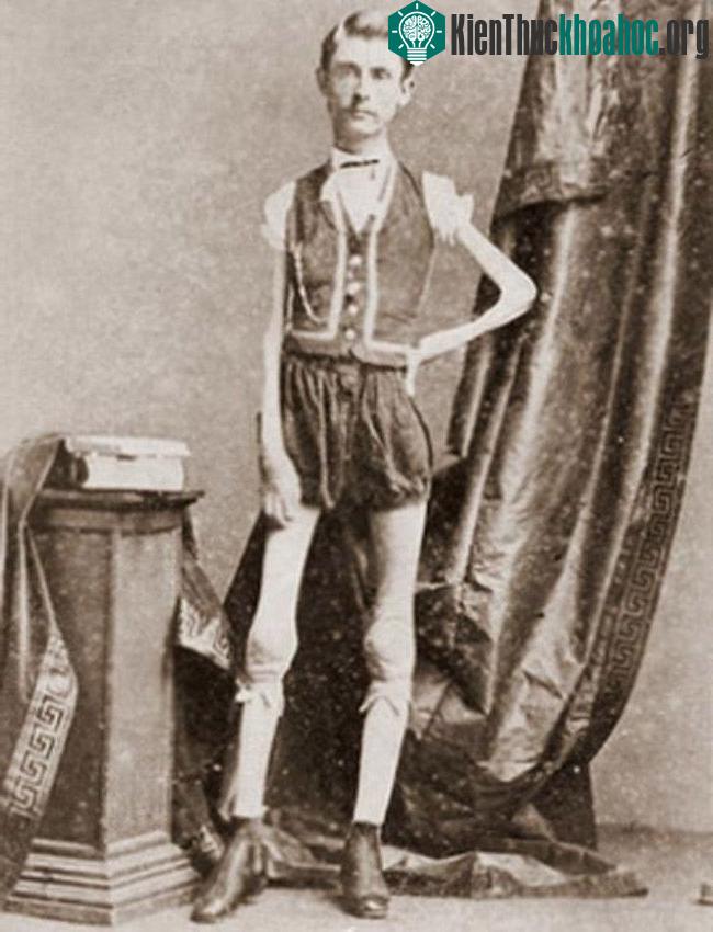 Isaac Sprague - bộ xương di động