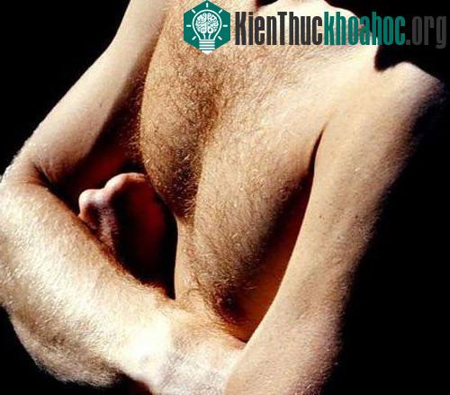 Cơ thể sản xuất nhiều testosterone nhiều hơn thì có lông rậm hơn.