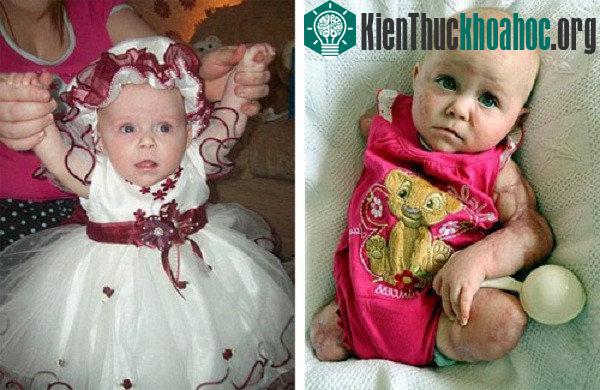 Bé Lillie trước và sau khi mắc căn bệnh lạ
