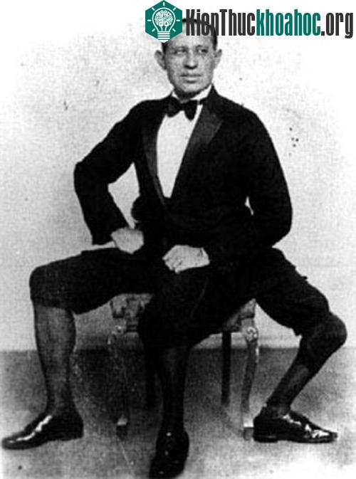 Francesco Lentini - người đàn ông 3 chân