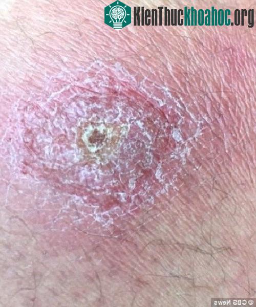 Elkins và Benenson không mắc bệnh, nhưng khoảng một nửa đoàn phải điều trị căn bệnh.