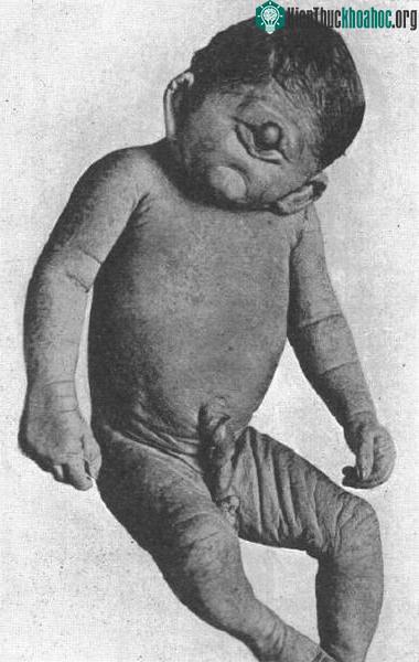 Trẻ mắc bệnh cyclopia.