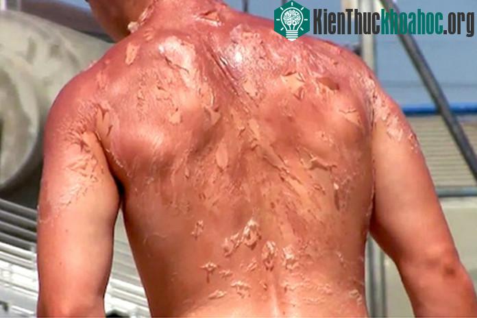 Những vệt cháy nắng thường có màu đỏ do máu dồn lên vết thương. Đồng thời, da chết sẽ tróc ra từng mảng khi vết thương lành.