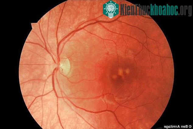 Đèn laser có thể để lại những tổn hại trên hoàng điểm.