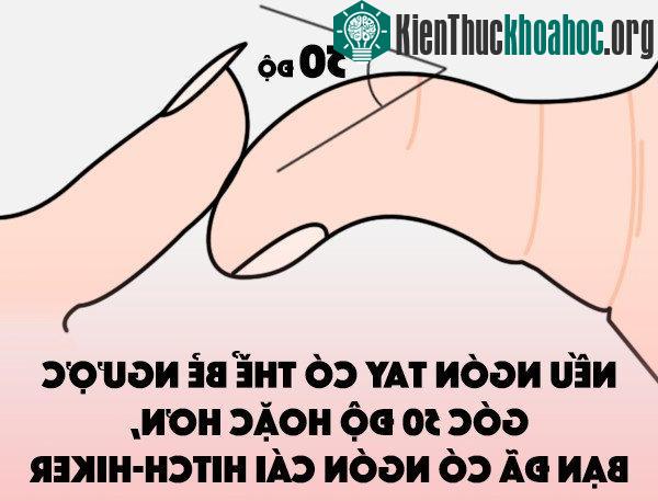 Ngón tay cái có thể bẻ ngược (Ngón cái hitch-hiker).