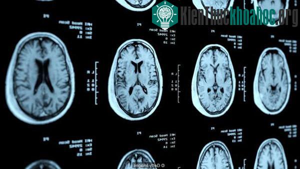 Não của người bị SPD có một số điểm khác so với người thường.