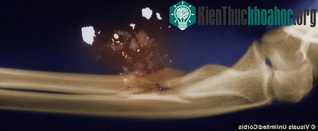 Trong rất nhiều trường hợp, đạn có thể va vào xương rồi đổi hướng ngay trong cơ thể.
