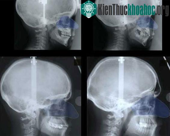 Ảnh trên bên trái: hộp sọ và mũi của một cậu bé trước tuổi dậy thì; ảnh trên bên phải: hộp sọ và mũi của một cô gái trước tuổi dậy thì; ảnh dưới bên trái: hộp sọ và mũi của người đàn ông trưởng thà...
