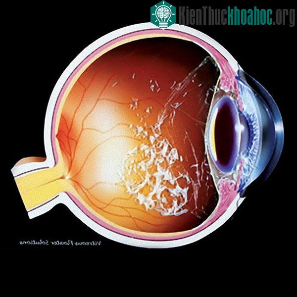 Dịch kính trong suốt và chiếm phần lớn thể tích nhãn cầu.