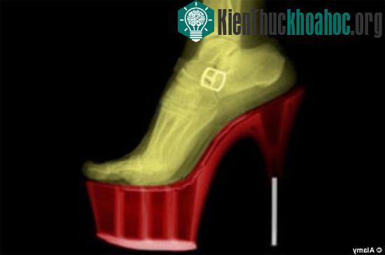 Đeo giày cao gót khiến bàn chân người phụ nữ mất đi trạng thái cân bằng tự nhiên. (Ảnh: Alamy)