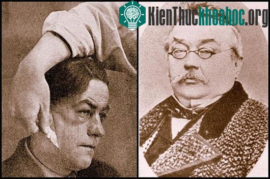 Ferdinand Ritter von Hebra - một trong những người tiên phong trong phương pháp "lột da mặt"