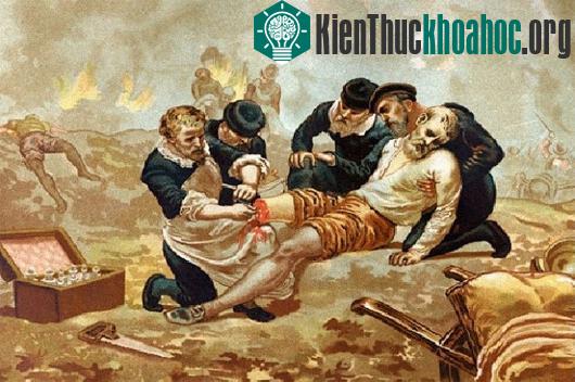 Bức ảnh diễn tả quá trình phẫu thuật của bác sĩ Ambroise Paré thế kỷ XVI