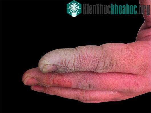 Quá trình axit đậm đặc phá hủy cơ thể con người