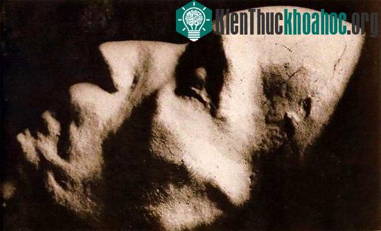 Khuôn mặt Beethoven khi được khám nghiệm tử thi