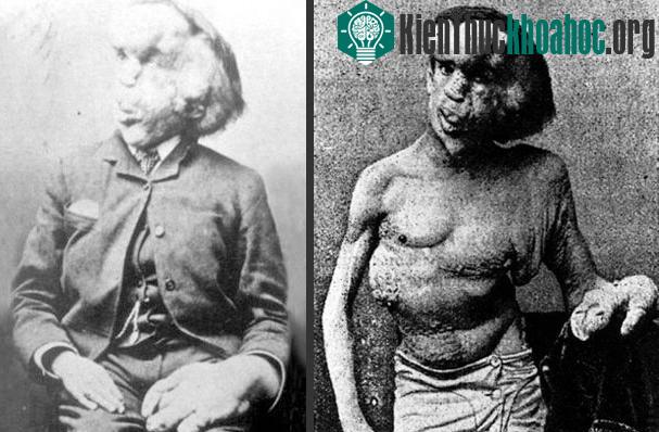 Joseph Merrick đã dũng cảm sống với thân phận “người voi”