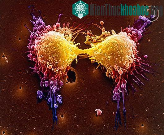 5 biến thể gen liên quan tới ung thư tiền liệt tuyến