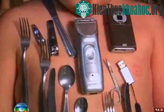 Thêm một cậu bé có “tài” hút dính kim loại