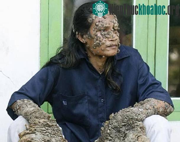 “Người cây” Dede Koswara ở Indonesia.