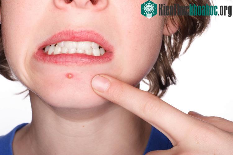 Kích thước của nang lông chính là câu trả lời cho vấn đề này. (Nguồn ảnh: gazettereview).