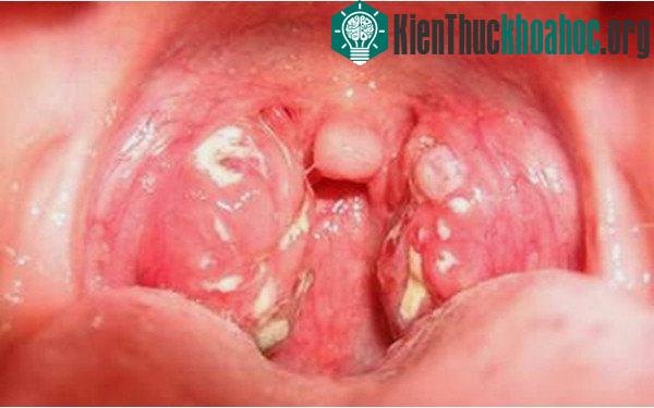 Chỉ cần tiếp xúc một lượng nhỏ canxi oxalat cũng đủ gây ngứa, nóng rát trong miệng, họng, sưng và ngạt thở.