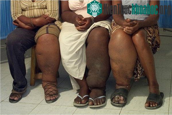 Giun chỉ có thể gây bệnh chân voi cho con người.