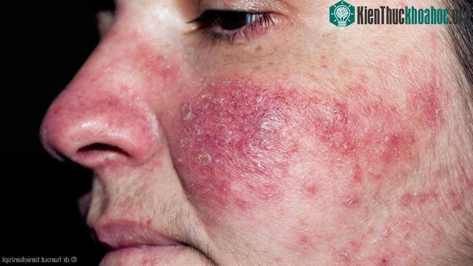 Gương mặt người bị chứng Rosacea