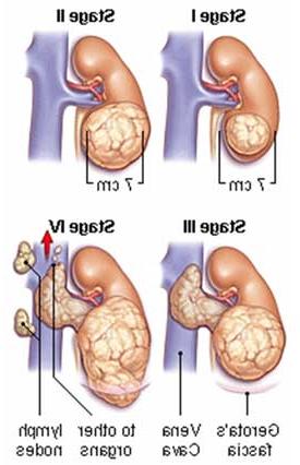 Hy vọng cho việc chữa trị ung thư thận ảnh 0