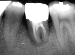 Lấy tế bào gốc từ mầm răng khôn ảnh 0