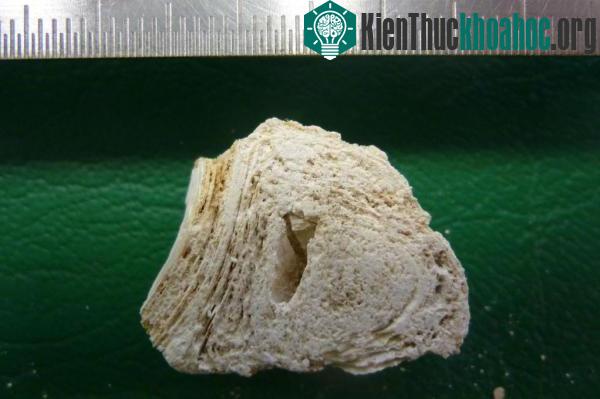 Mặt cắt ngang của một trong những nốt sần trên xương sườn người phụ nữ. (Ảnh: Pathologie Nordhessen).
