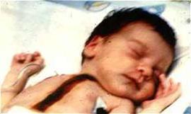 Lồng ngực bé gái Baby Fae được đặt trái tim của một con khỉ đầu chó