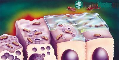 Giới y khoa biết rằng quả thật vi khuẩn H. pylori là thủ phạm của khoảng 80% đến 90% các trường hợp loét dạ dày