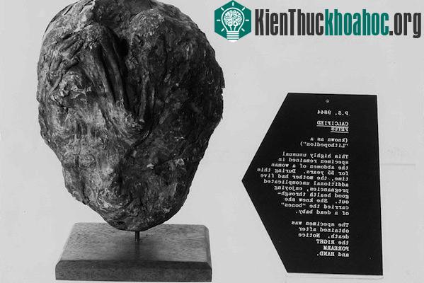 Hình ảnh về một bào thai hóa đá, lithopedion, tồn tại trong cơ thể một phụ nữ suốt 55 năm. Trong thời gian mang bào thai hóa đá, người phụ nữ vẫn trải qua 5 thai kỳ không gặp vấn đề gì. (Ảnh: Wikip...