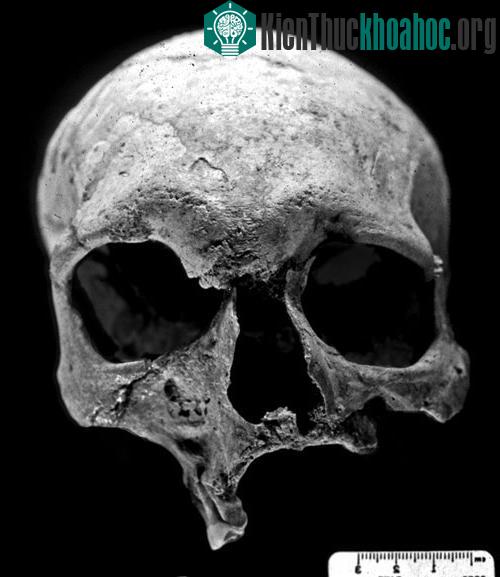 Bằng chứng cổ nhất về bệnh hủi. (Ảnh: LiveScience)